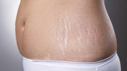 Stretch Marks opti