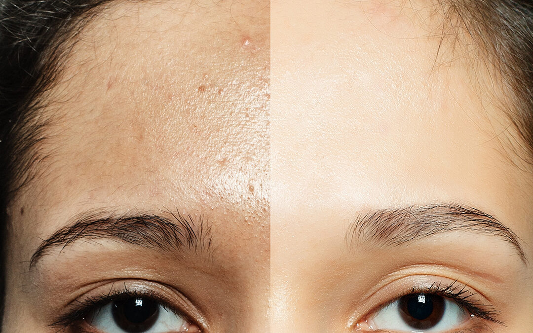 How to achieve blemish free skin with Vitamin C