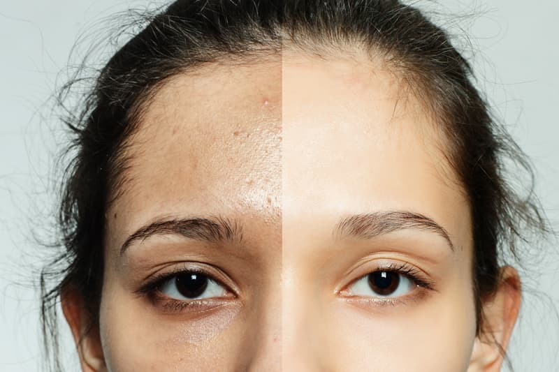 How-to-achieve-blemish-free-skin-with-vitamin-C opti